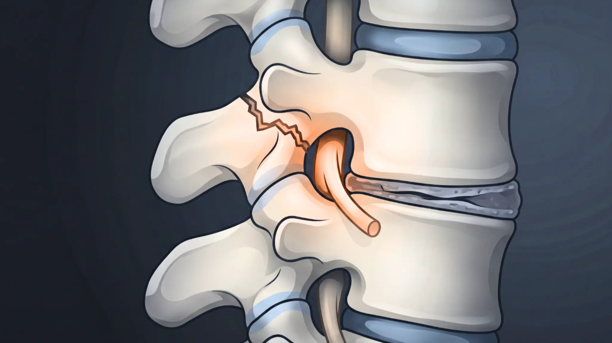 Medical illustration of lumbar spondylolisthesis showing a pars fracture, forward vertebral slip, collapsed disc, and nerve root compression zone.